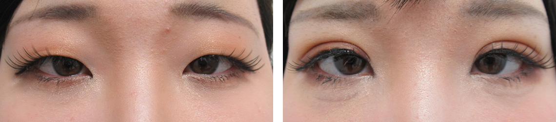 二重埋没法の症例写真 施術前後 １週間