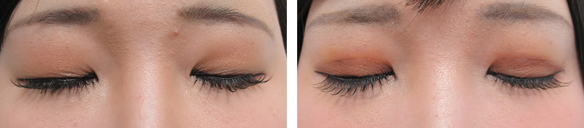 二重埋没法の症例写真 施術前後 １週間