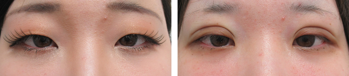 二重埋没法の症例写真 施術前後 直後