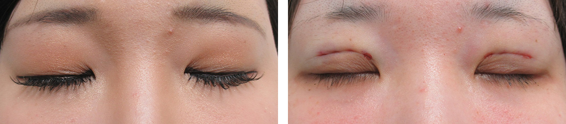 二重埋没法の症例写真 施術前後 直後