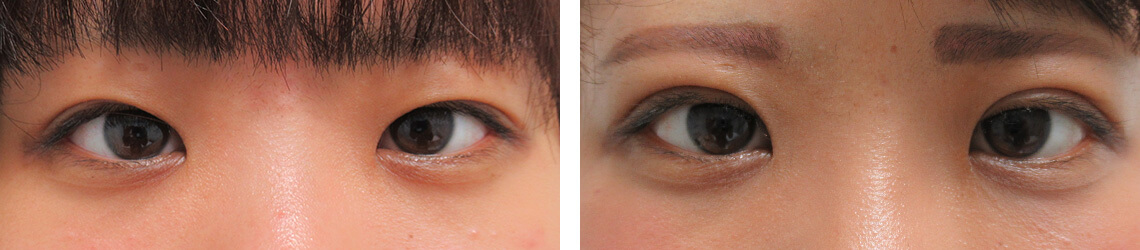 二重埋没法の症例写真 施術前後 １ヵ月