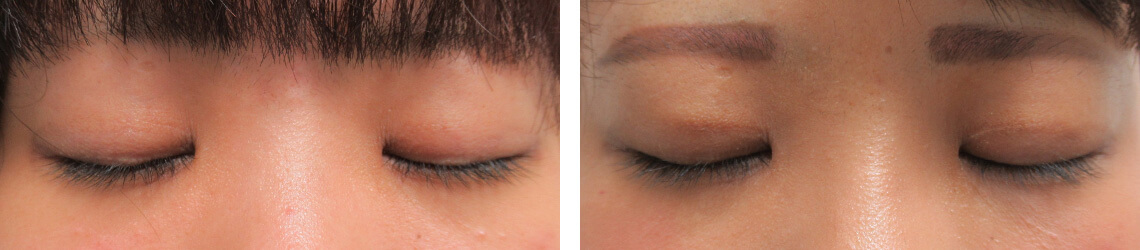 二重埋没法の症例写真 施術前後 １ヵ月