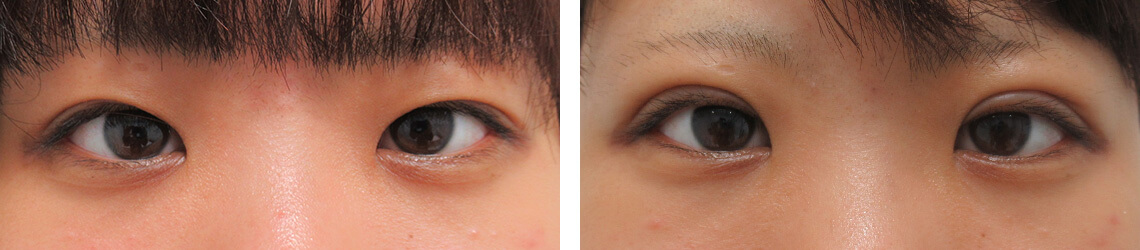 二重埋没法の症例写真 施術前後 １週間