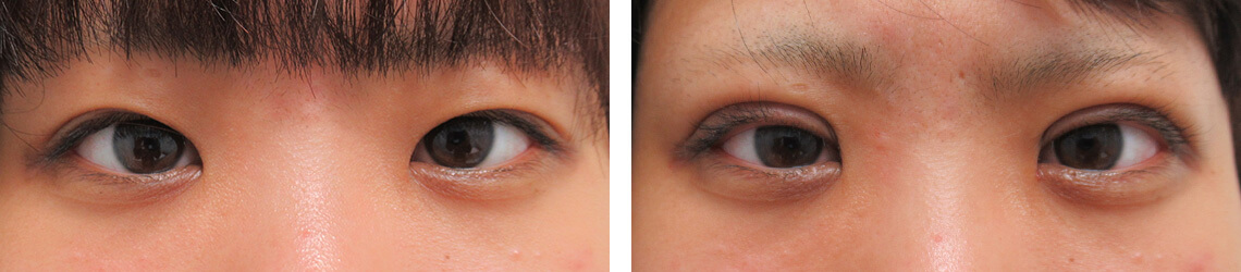 二重埋没法の症例写真 施術前後 直後