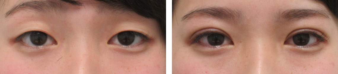 二重埋没法の症例写真 施術前後 直後