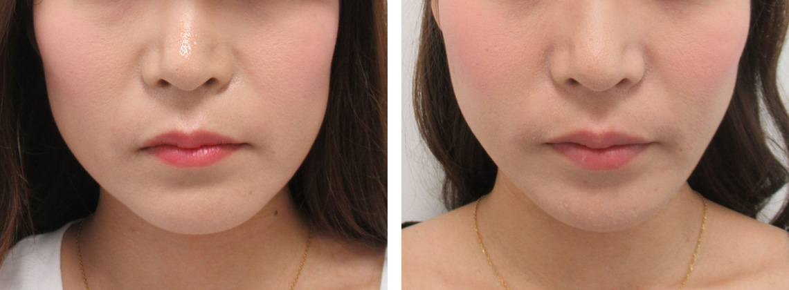 TAC式 ツヤ肌コラーゲンリフト®/ボトックス注射：その他の症例写真 施術前後 １週間