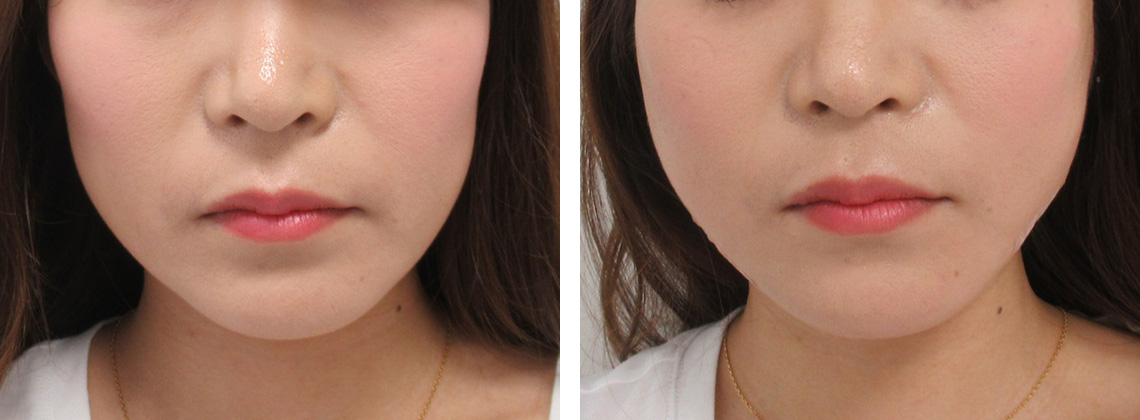 TAC式 ツヤ肌コラーゲンリフト®/ボトックス注射：その他の症例写真 施術前後 直後