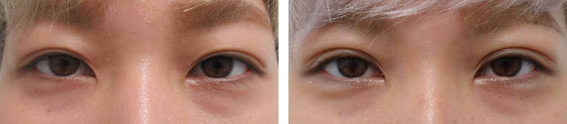 二重の幅を少し広げたい