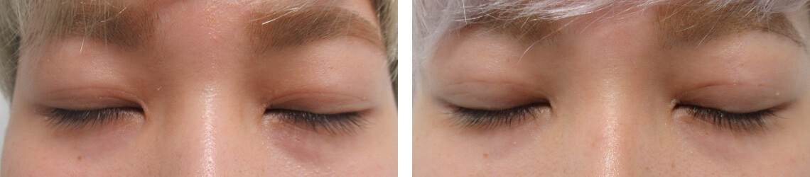 二重埋没法の症例写真 施術前後 １ヵ月