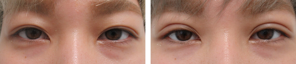 二重埋没法の症例写真 施術前後 １週間