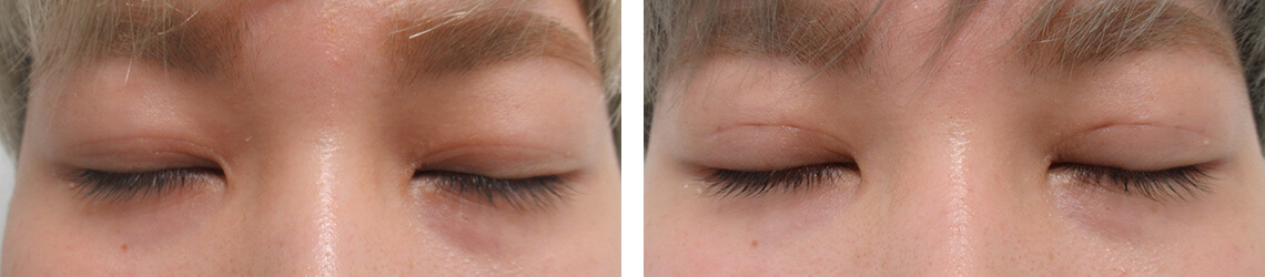 二重埋没法の症例写真 施術前後 １週間