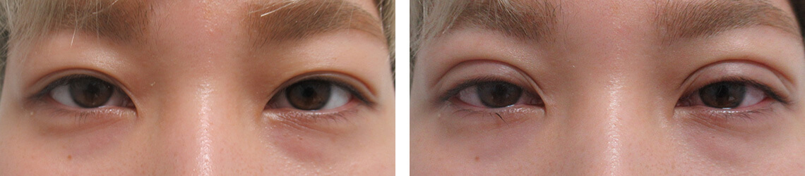 二重埋没法の症例写真 施術前後 直後