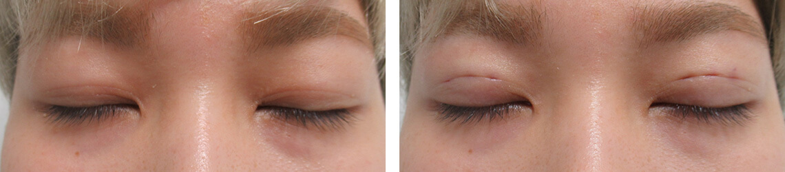 二重埋没法の症例写真 施術前後 直後