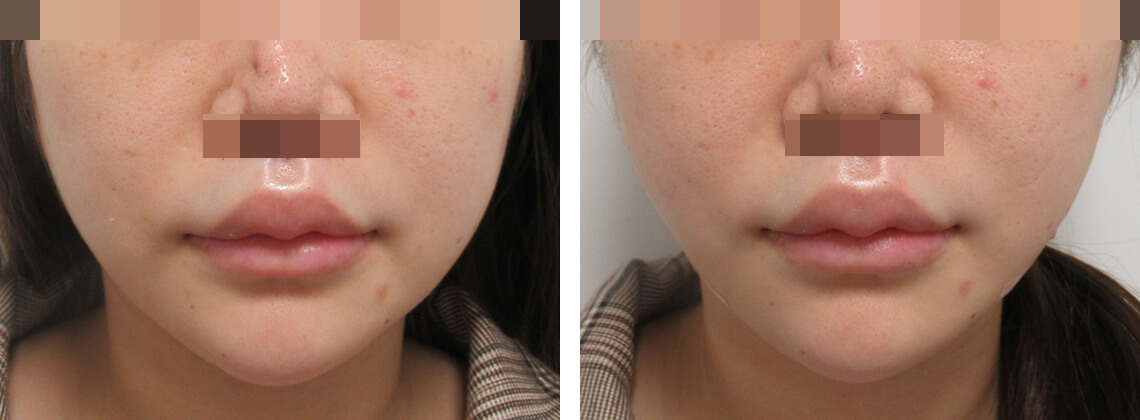 TAC式 ツヤ肌コラーゲンリフト®/ボトックス注射：その他の症例写真 施術前後 直後