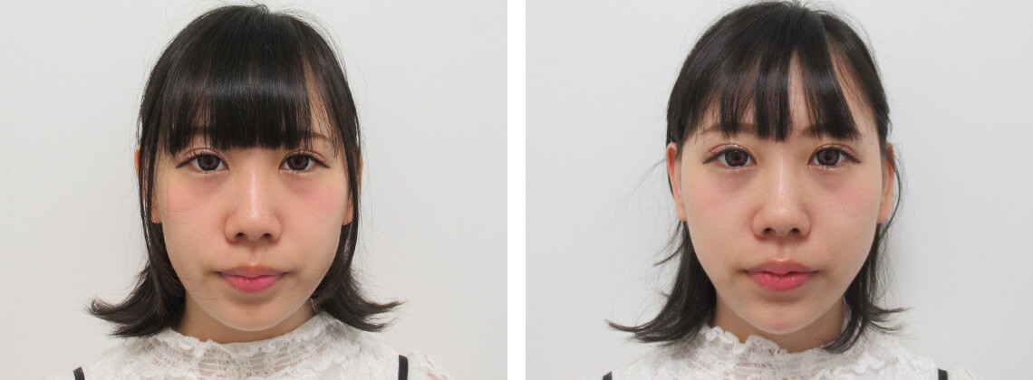 TAC式 ツヤ肌コラーゲンリフト®/ヒアルロン酸注射：その他/ボトックス注射：その他の症例写真 施術前後 直後