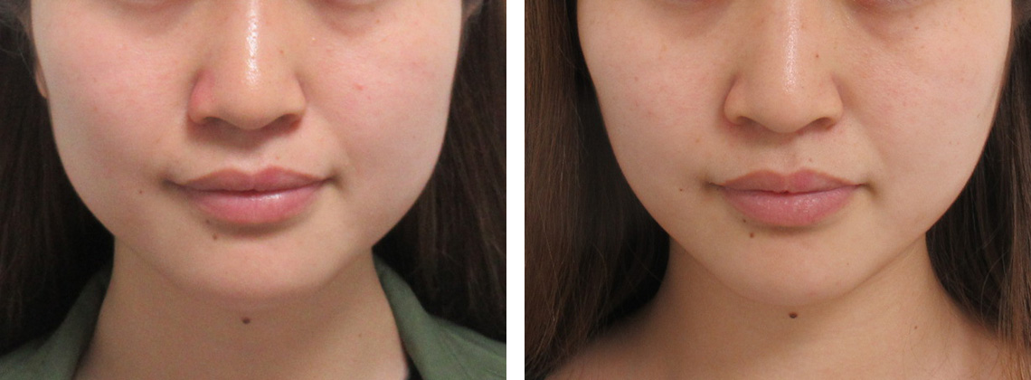 TAC式 ツヤ肌コラーゲンリフト®/ボトックス注射：その他の症例写真 施術前後 １ヵ月