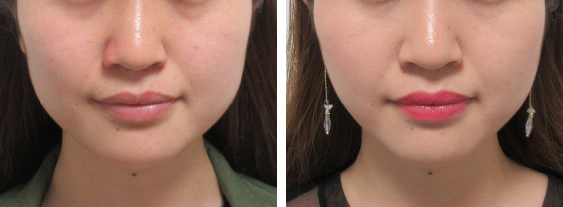 TAC式 ツヤ肌コラーゲンリフト®/ボトックス注射：その他の症例写真 施術前後 １週間