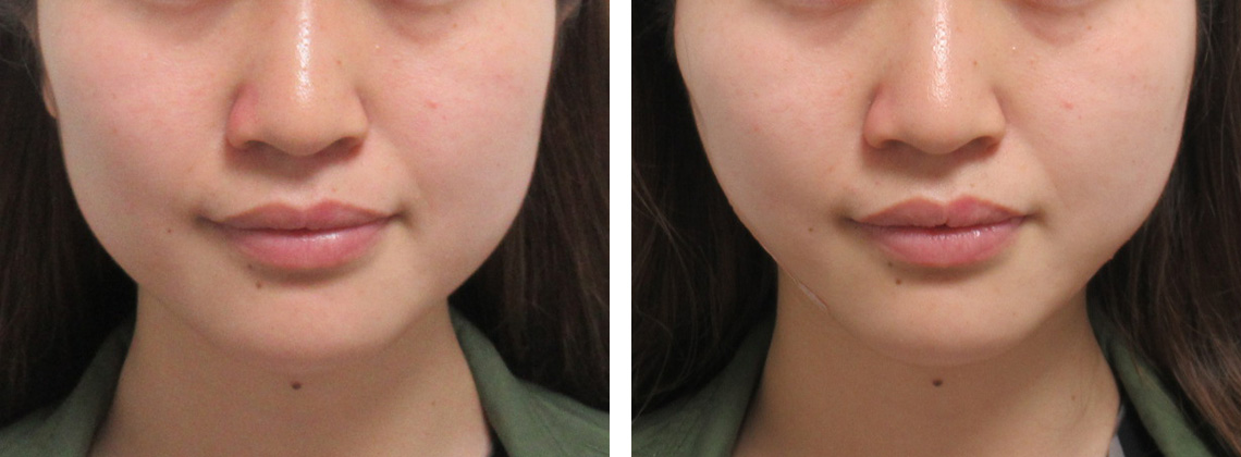 TAC式 ツヤ肌コラーゲンリフト®/ボトックス注射：その他の症例写真 施術前後 直後