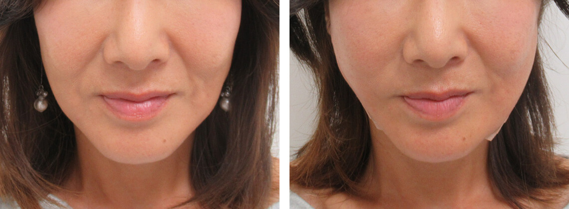 TAC式 ツヤ肌コラーゲンリフト®の症例写真 施術前後 直後
