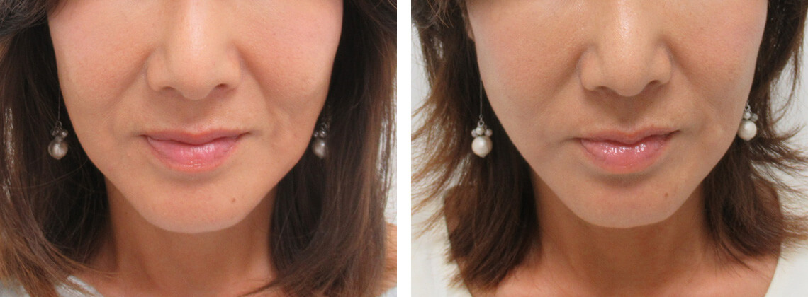 TAC式 ツヤ肌コラーゲンリフト®の症例写真 施術前後 1ヵ月