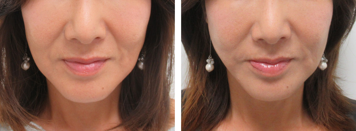 TAC式 ツヤ肌コラーゲンリフト®の症例写真 施術前後 1週間