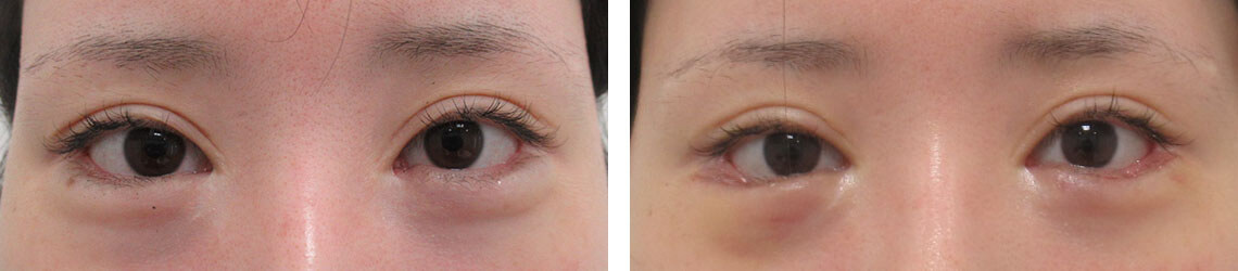 グラマラスライン(タレ目形成)の症例写真 施術前後 1週間