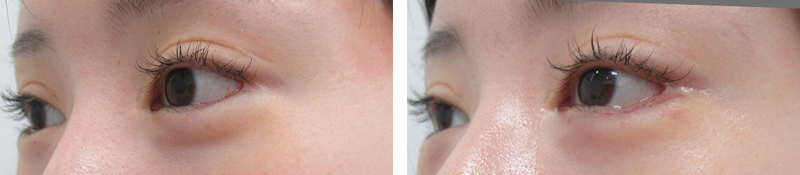 グラマラスライン(タレ目形成)の症例写真 施術前後 1週間