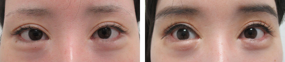 グラマラスライン(タレ目形成)の症例写真 施術前後 5ヵ月