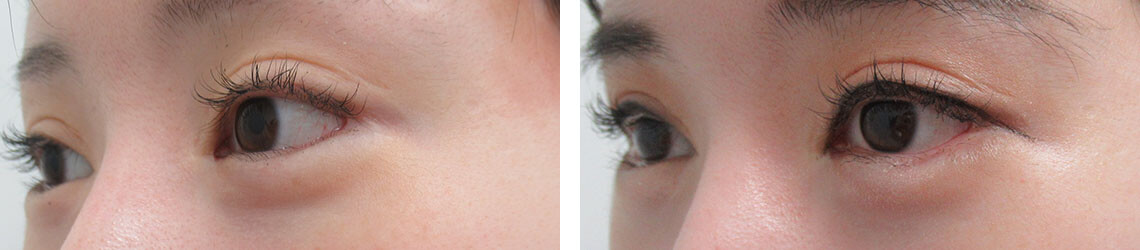 グラマラスライン(タレ目形成)の症例写真 施術前後 5ヵ月