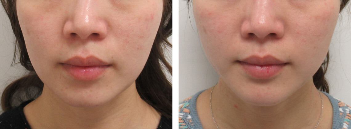 フェイスラインのもたつき