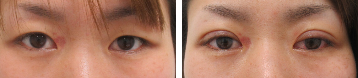 二重埋没法の症例写真 施術前後 直後