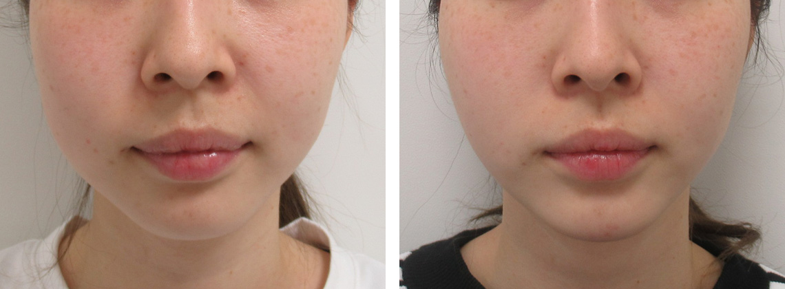 左右差があるリフトアップ