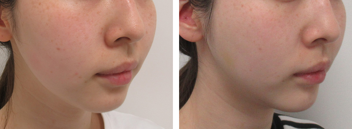 TAC式 ツヤ肌コラーゲンリフト®の症例写真 施術前後 １ヵ月