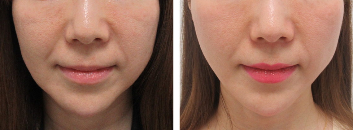 リフト直後の腫れも落ち着きます