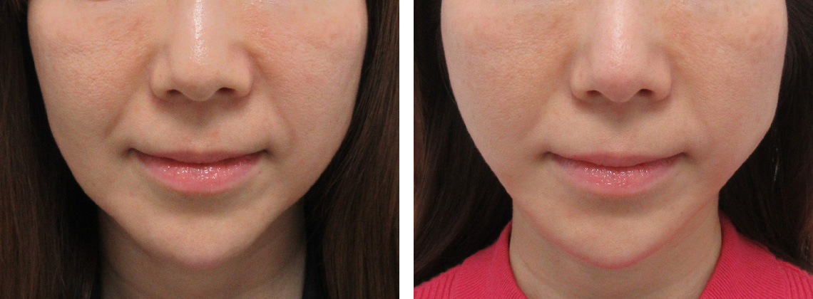 TAC式 ツヤ肌コラーゲンリフト®の症例写真 施術前後 １週間