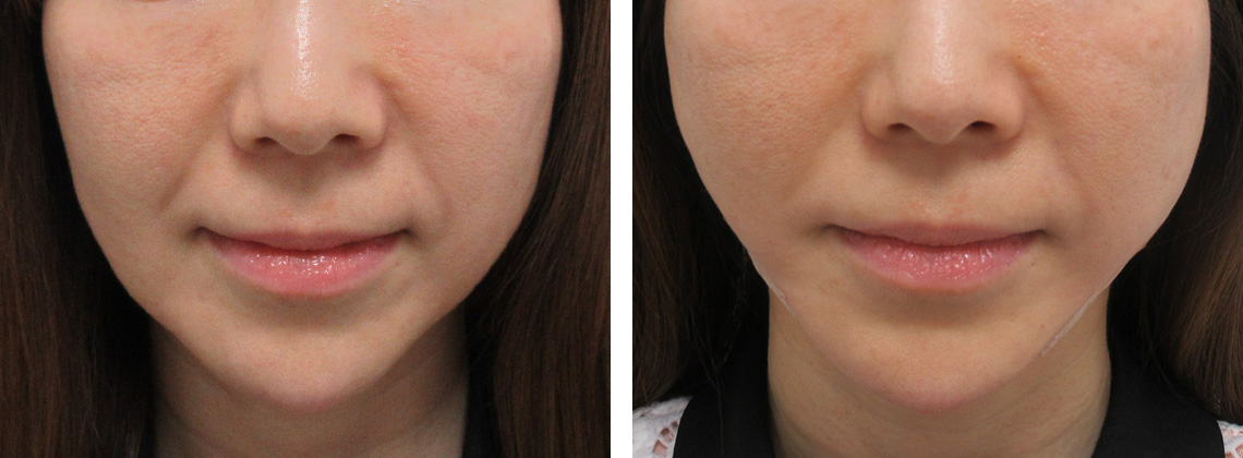 TAC式 ツヤ肌コラーゲンリフト®の症例写真 施術前後 直後