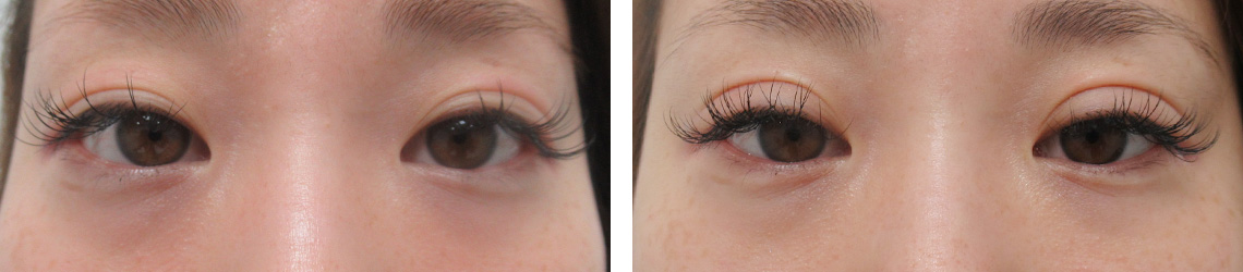 埋没法で幅広な二重に