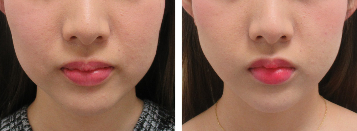 リフトアップのダウンタイム長めの方