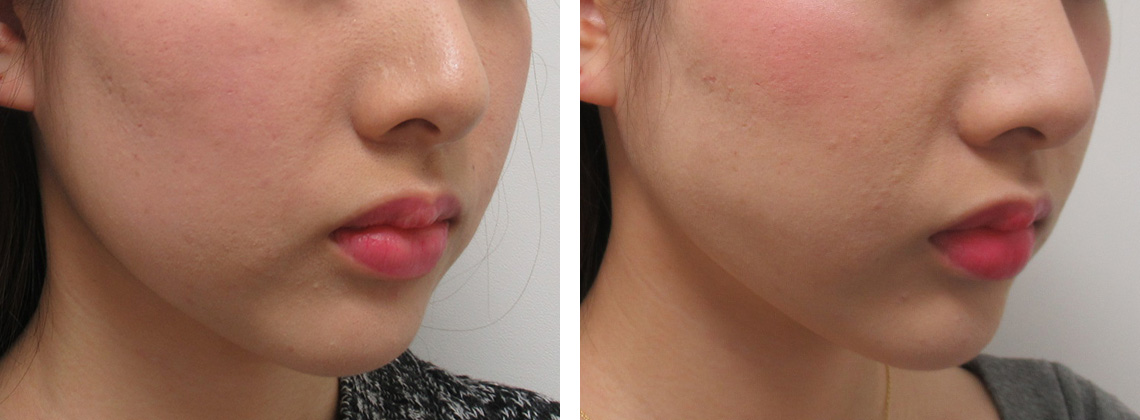 TAC式 ツヤ肌コラーゲンリフト®/エラボトックス注射/顎のヒアルロン酸注射の症例写真 施術前後 １ヵ月