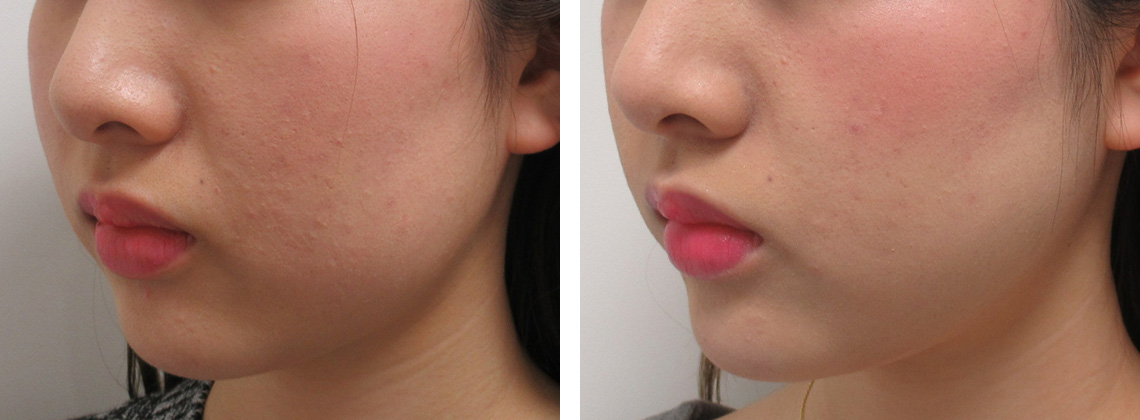 TAC式 ツヤ肌コラーゲンリフト®/エラボトックス注射/顎のヒアルロン酸注射の症例写真 施術前後 １ヵ月