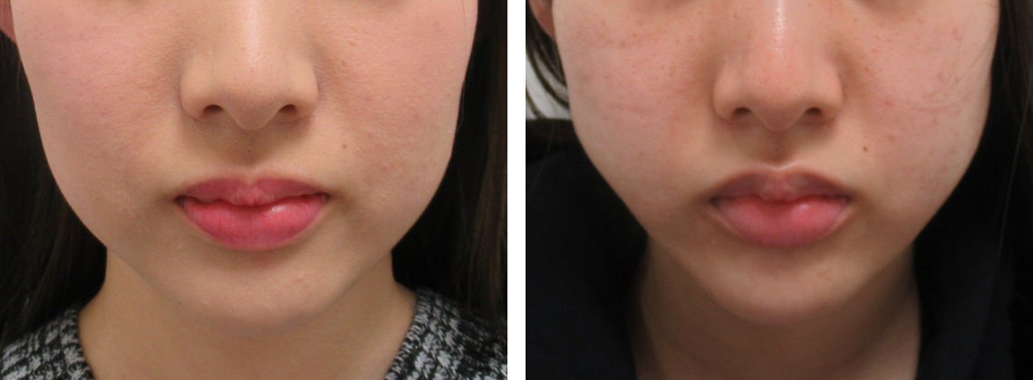 TAC式 ツヤ肌コラーゲンリフト®/エラボトックス注射/顎のヒアルロン酸注射の症例写真 施術前後 １週間