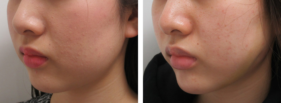 TAC式 ツヤ肌コラーゲンリフト®/エラボトックス注射/顎のヒアルロン酸注射の症例写真 施術前後 １週間