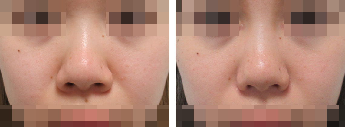 鼻翼縮小でコンプレックス解消