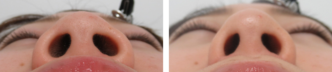 TAC式 鼻翼縮小術（小鼻縮小）/鼻のヒアルロン酸注射の症例写真 施術前後 ３ヵ月