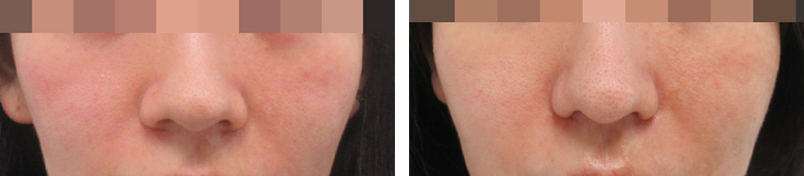 笑ったときに広がる小鼻