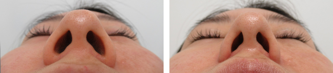 TAC式 鼻翼縮小術（小鼻縮小）の症例写真 施術前後 １ヵ月
