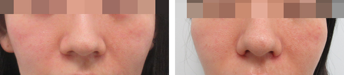 TAC式 鼻翼縮小術（小鼻縮小）の症例写真 施術前後 １週間