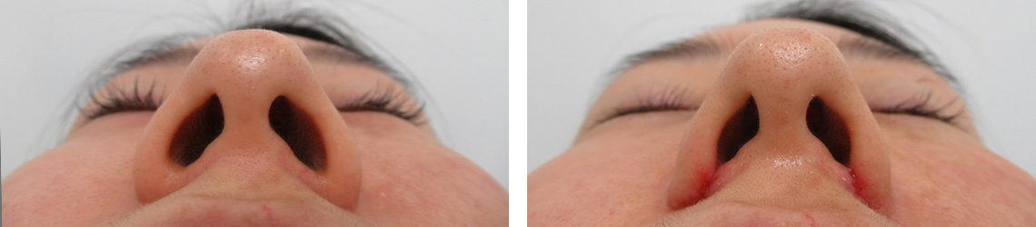 TAC式 鼻翼縮小術（小鼻縮小）の症例写真 施術前後 １週間