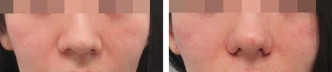TAC式 鼻翼縮小術（小鼻縮小）の症例写真 施術前後 直後