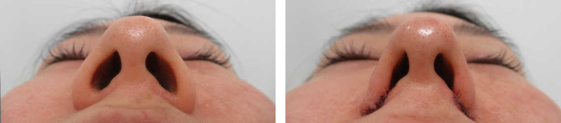 TAC式 鼻翼縮小術（小鼻縮小）の症例写真 施術前後 直後